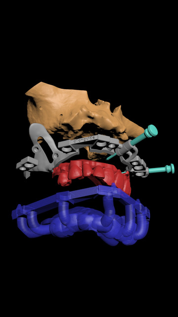 Stackable Surgical Guides: Single Restoration Operation